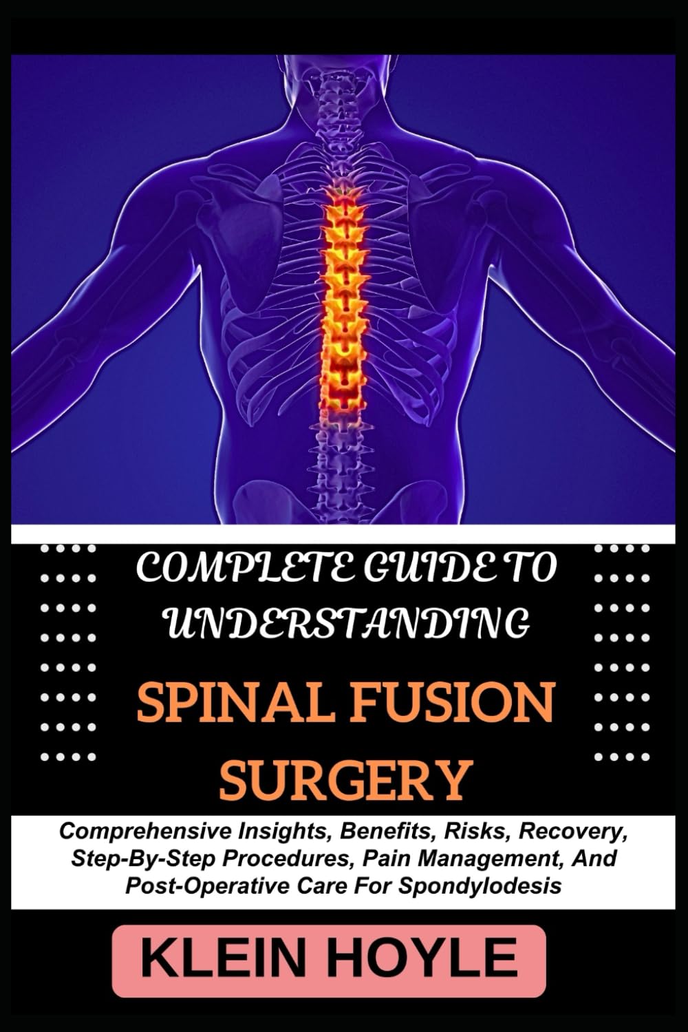 COMPLETE GUIDE TO UNDERSTANDING SPINAL FUSION SURGERY: Comprehensive Insights, Benefits, Risks, Recovery, Step-By-Step Procedures, Pain Management, And Post-Operative Care For Spondylodesis
