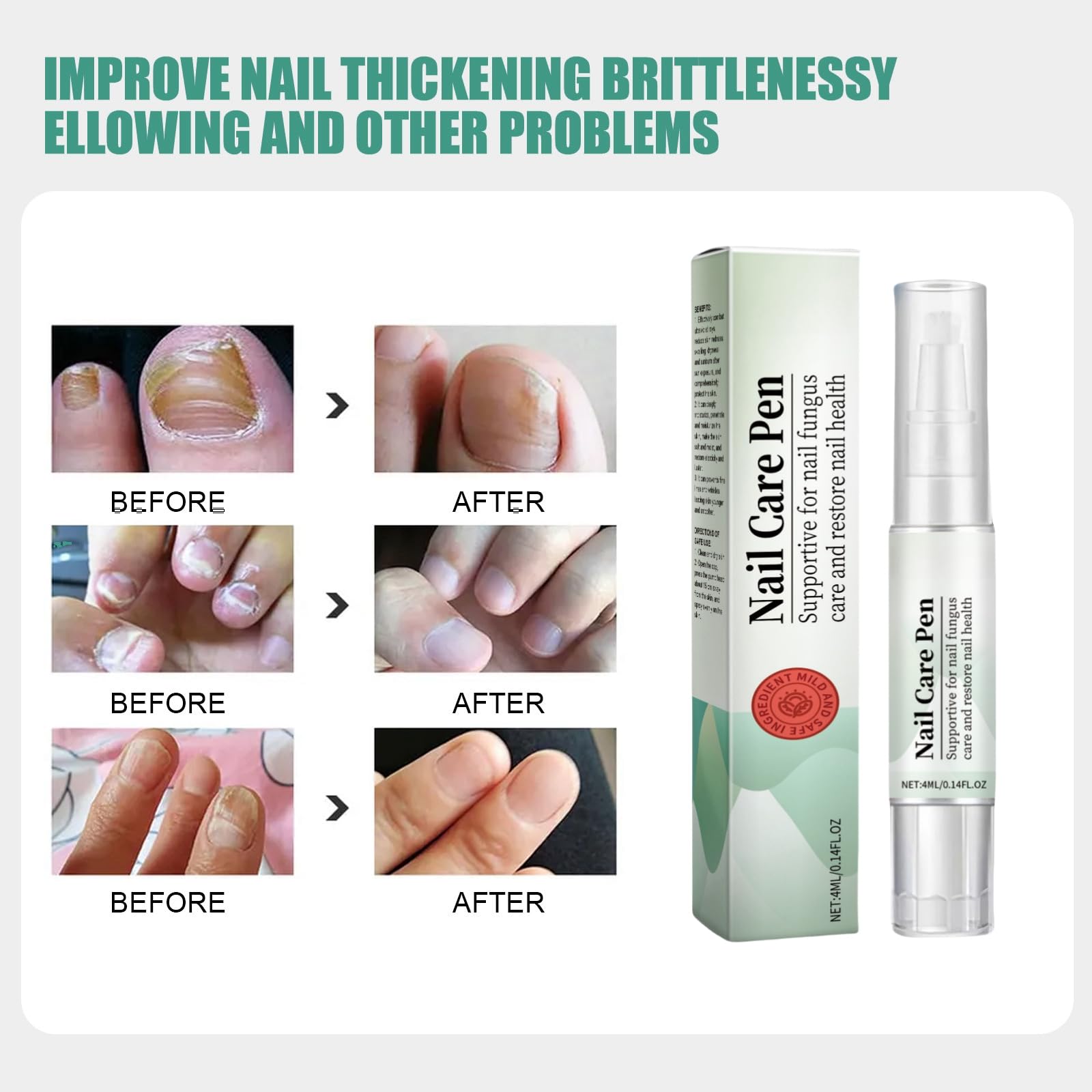 2PCS Nail Care Pen,Fungal Nail Treatment Pen,Cosmetic Care for Nail Fungus,Toenail Fungus Treatment Pen,Fungal Toenail Treatment,Antifungal Nail Polish,Nail Repair Pen for Nail - Image 2