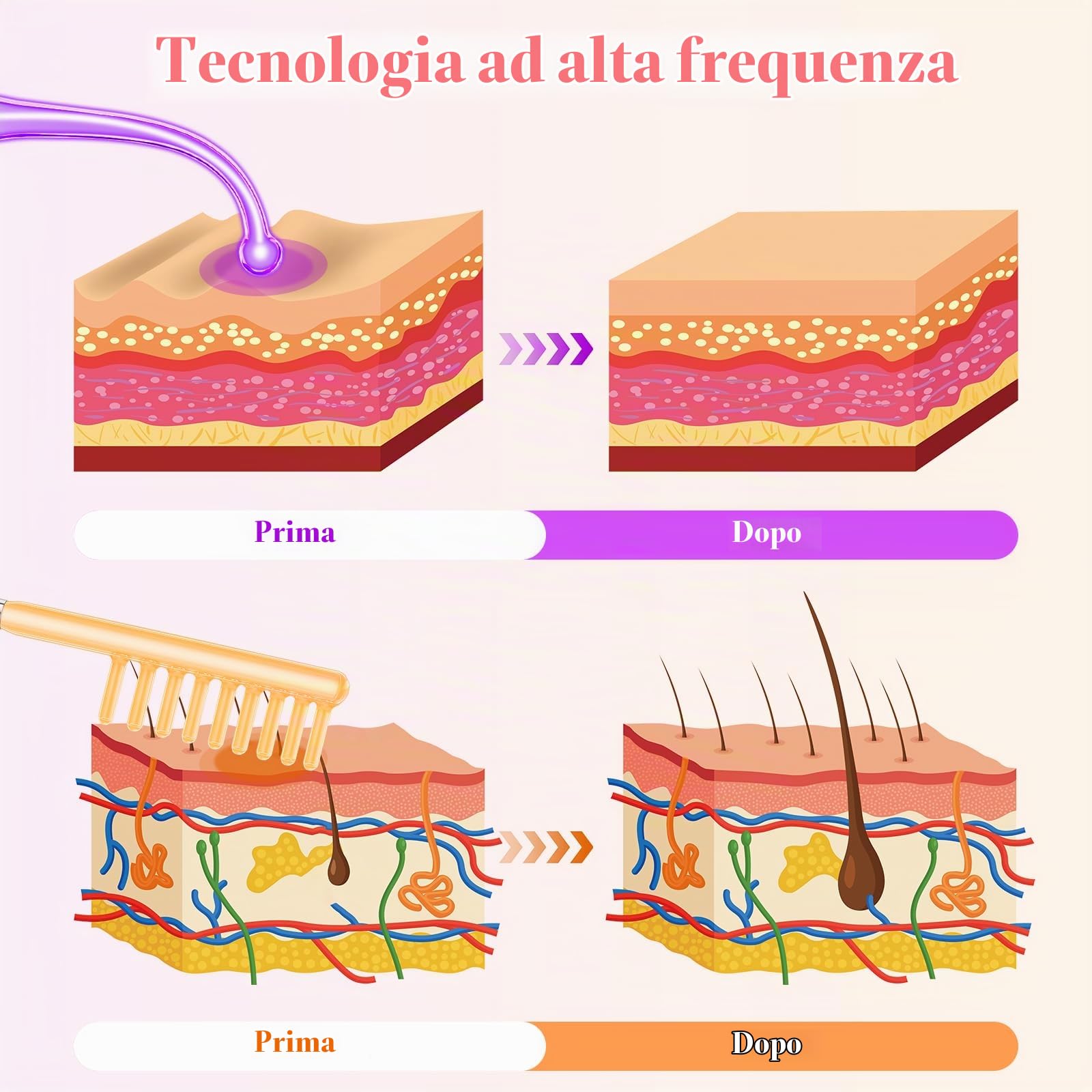 Alta Frequenza Viso, iklestar Macchina Facciale ad Alta Frequenza di per la crescita dei Capelli con 6 Tubi di Vetro, Kit di Bacchette palmari ad Alta Frequenza per uso Domestico