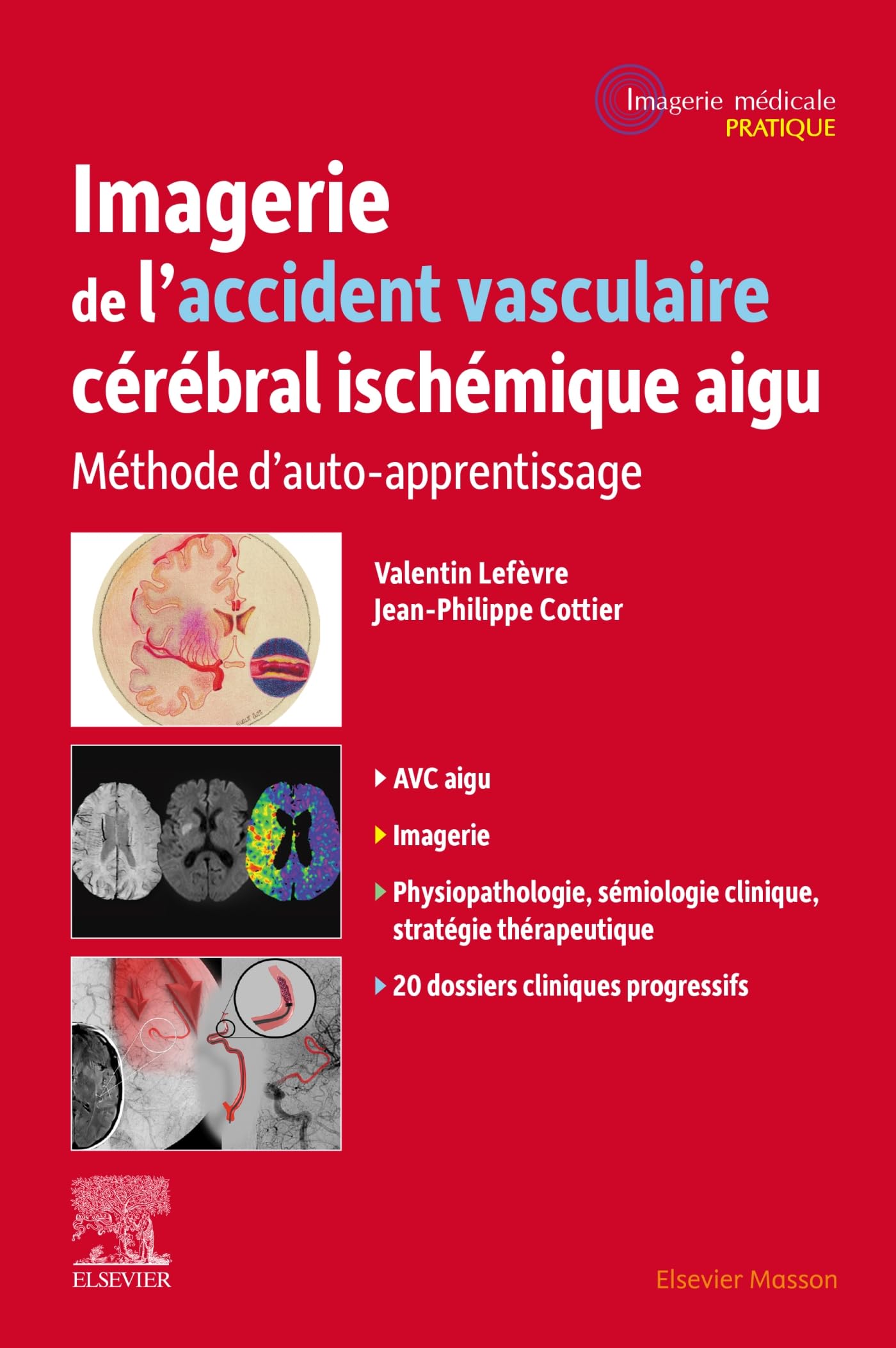 Imagerie de l'accident vasculaire cérébral ischémique aigu: Méthode d'auto-apprentissage