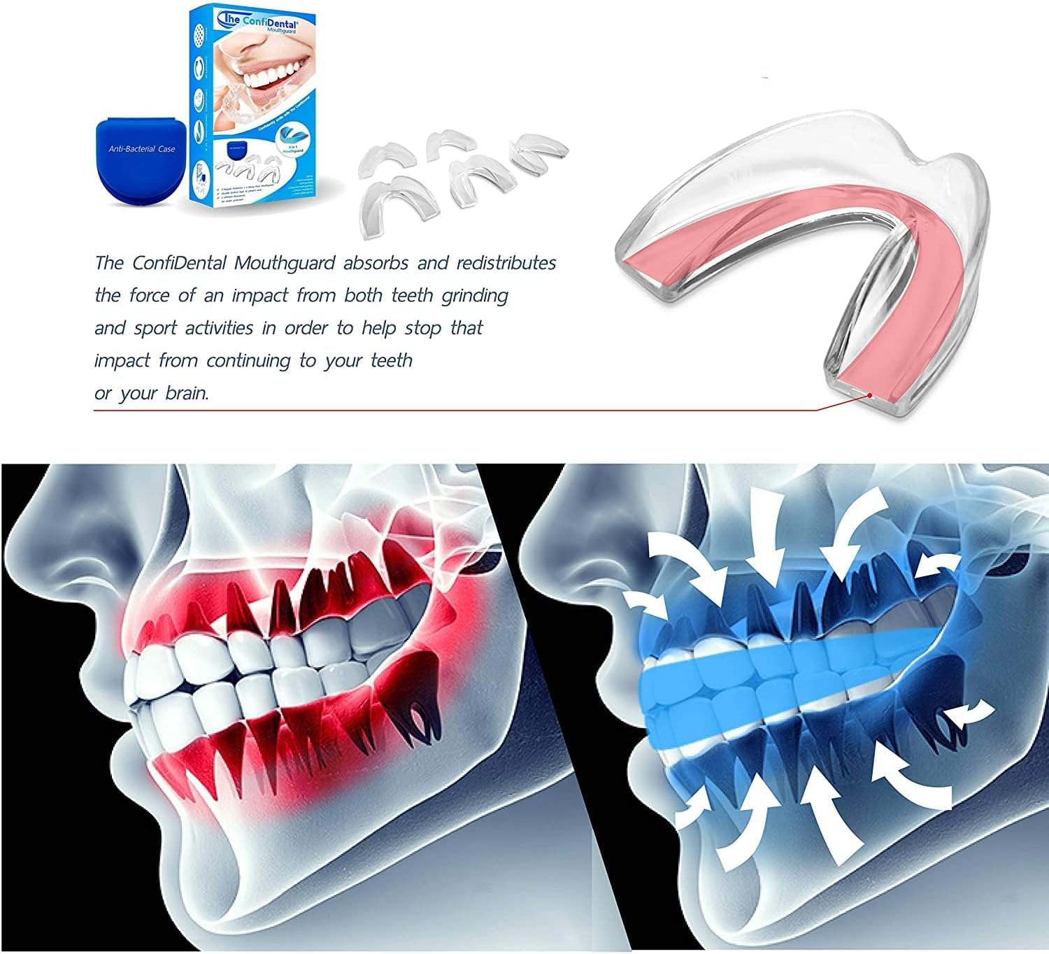 Protectores de boca moldeables para bruxismo, paquete de 5, 3 regulares y 2 resistentes