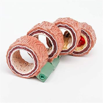 4-Piece Artery Model with Detachable Base, Realistic Human Artery Blood Vessel Anatomy Model, Arteriosclerosis Teaching Tool for Anatomy and Physiology Education