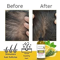 Vista 5 de Aceite de romero para el crecimiento del cabello, infundido con biotina para un crecimiento más rápido del cabello, suero de crecimiento extremo
