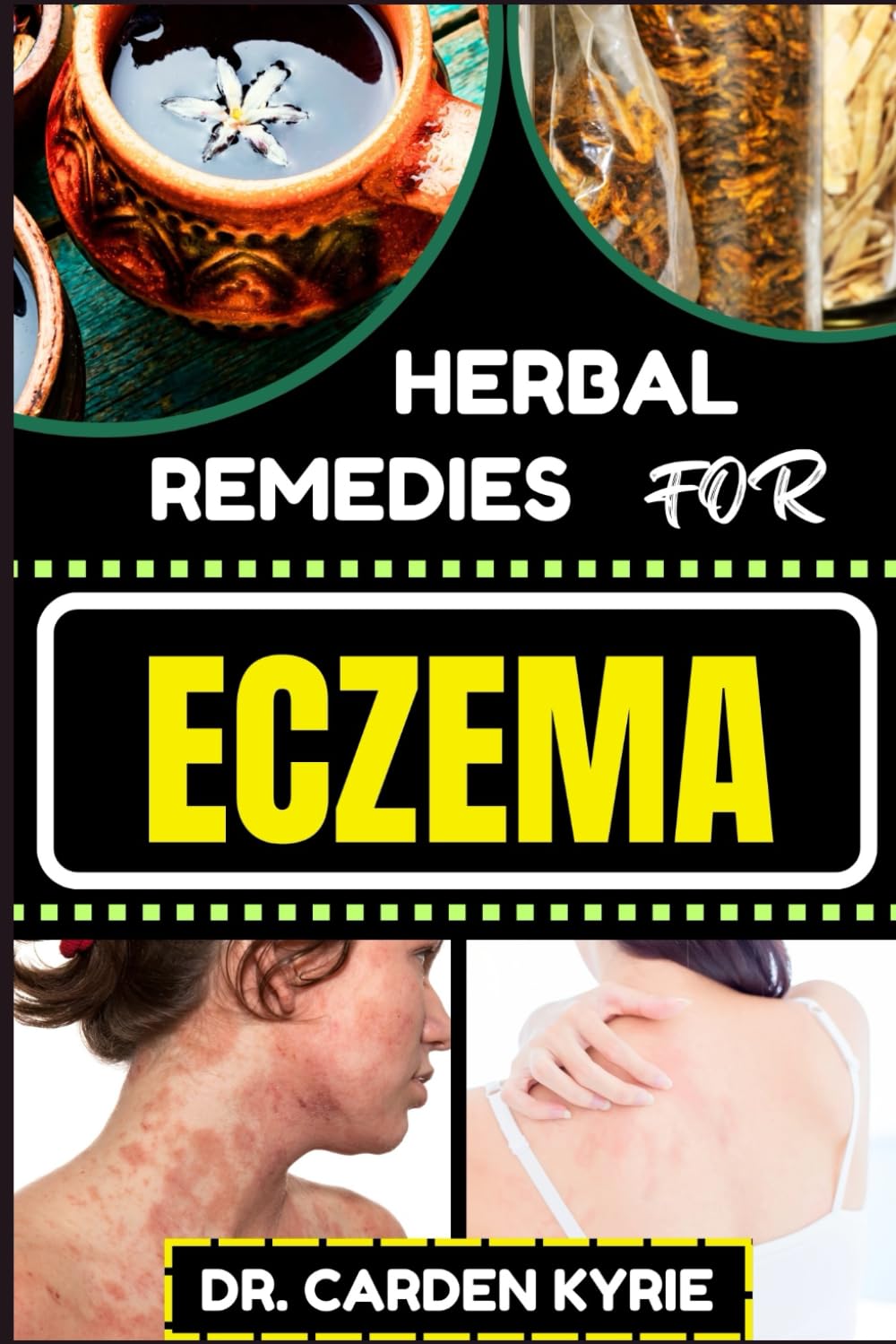 HERBAL REMEDIES FOR ECZEMA: Unlocking Nature's Healing Power With Herbs For Flourishing Skin, Holistic Wellness, Lasting Relief And Healthy Lifestyle