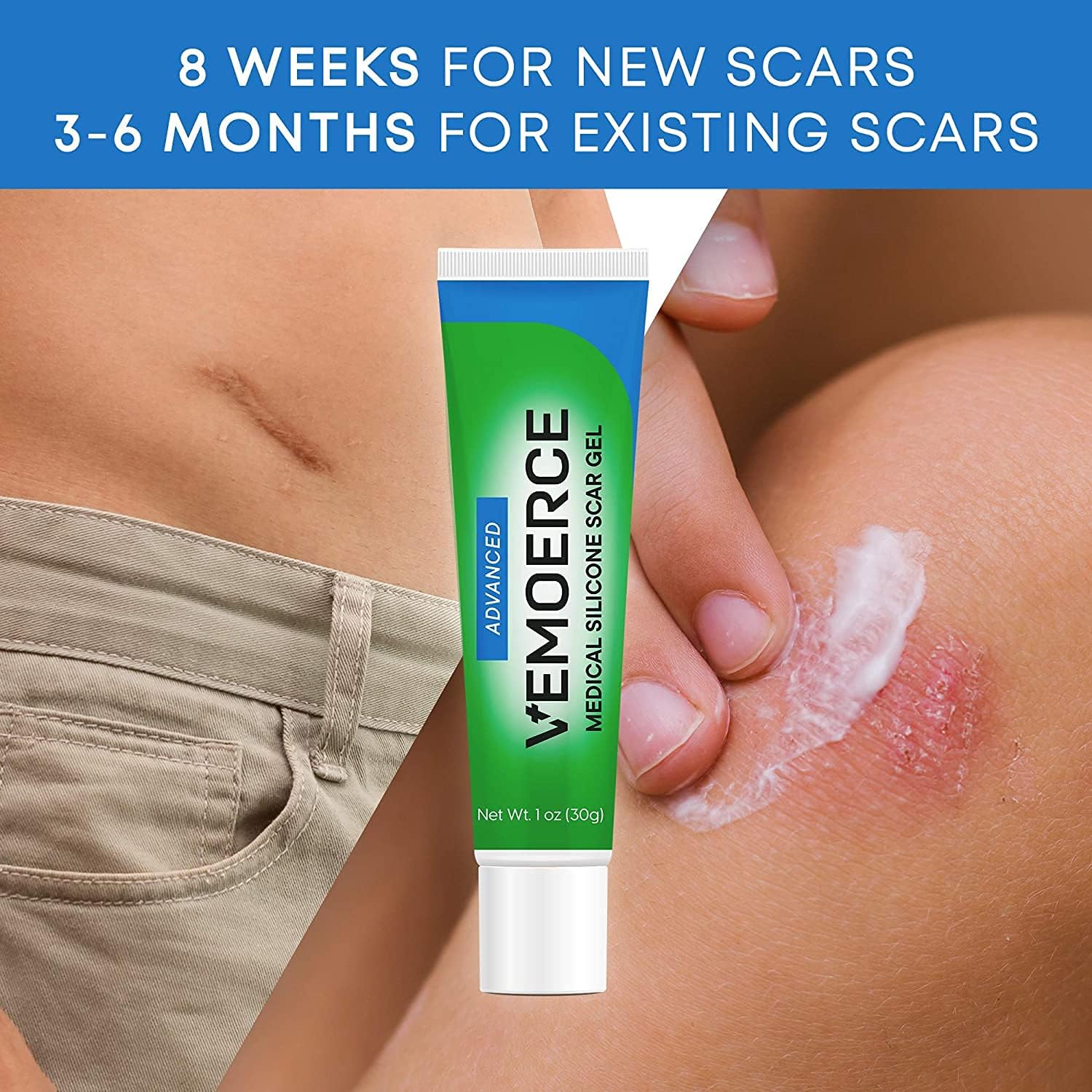 Vemoerce Scar Removal Gel with Silicone, Silicone Scar Gel for Surgical Scars, for Face, Scar Gel with Silicone for Keloids, C-Section, Cosmetic Procedures, Burns, Injuries 30 g : Health & Household