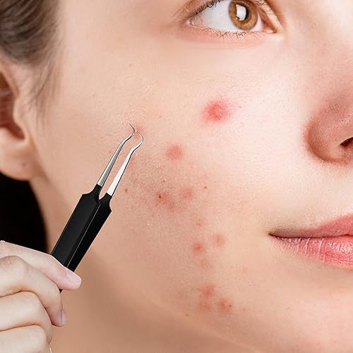 Miniatura 5 de 3 pinzas para puntos negros, de acero inoxidable, extractor de espinillas, herramienta para eliminar puntos negros, espinillas, espinillas, curva