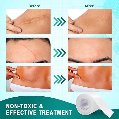 Miniatura 3 de Hojas de cicatriz de silicona para cicatrices quirúrgicas cinta de silicona transparente (rollo de 1.6 x 60 pulgadas, rollo de 4.9 ft) para cesárea,