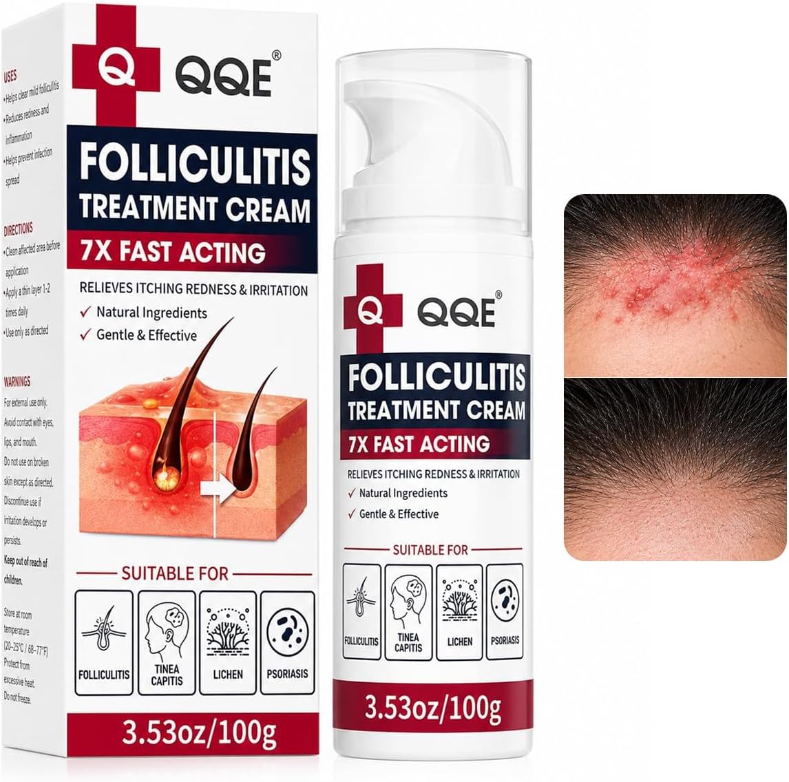 Benzoyl Peroxide Folliculitis Cream, Anti Itch Cream Extra Strength, Fast-Acting Acne Cream for Folliculitis, Razor Bumps & Ingrown Hair, Itch Cream, Psoriasis Scalp Treatment, 3.53 Oz