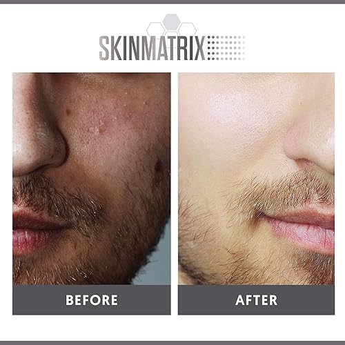 Miniatura 5 de YISHIQI- Almohadillas antimanchas para el control del acné contiene ácido salicílico, láctico y mandélico. Limpia los poros obstruidos, los puntos