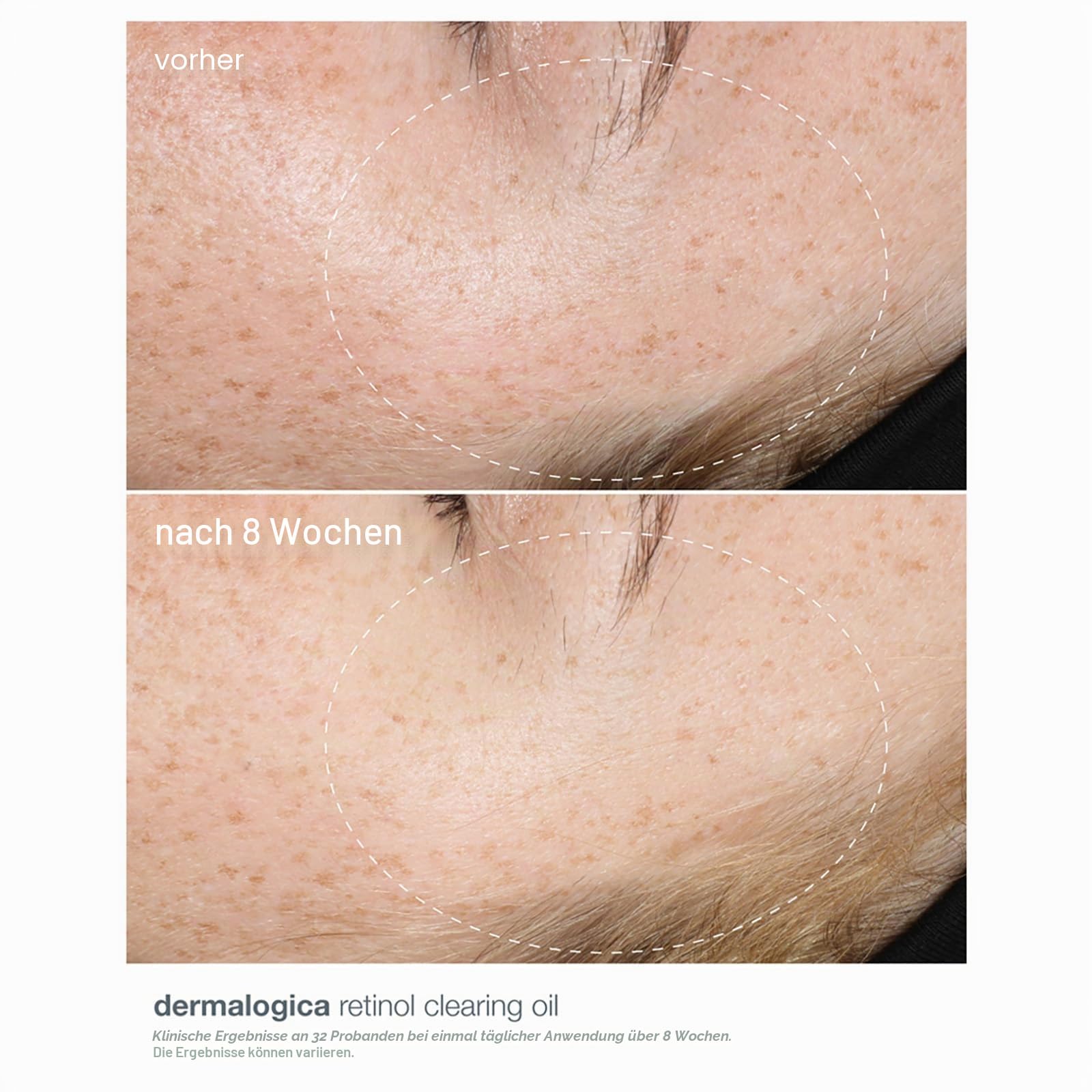 Dermalogica Retinol Clearing Oil bei Unreinheiten 30ml | Retinol-Gesichtsöl, das feine Linien und Unreinheiten gezielt behandelt und die Hautregeneration unterstützt.