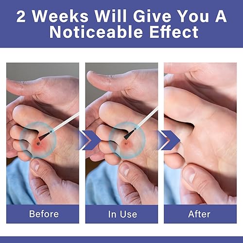 Miniatura 4 de Vifycim Removedor de maíz para pies, alivio del dolor de maíz extra fuerte para pies, dedos de los pies, manos, maíz de pies y callos, acción rápida