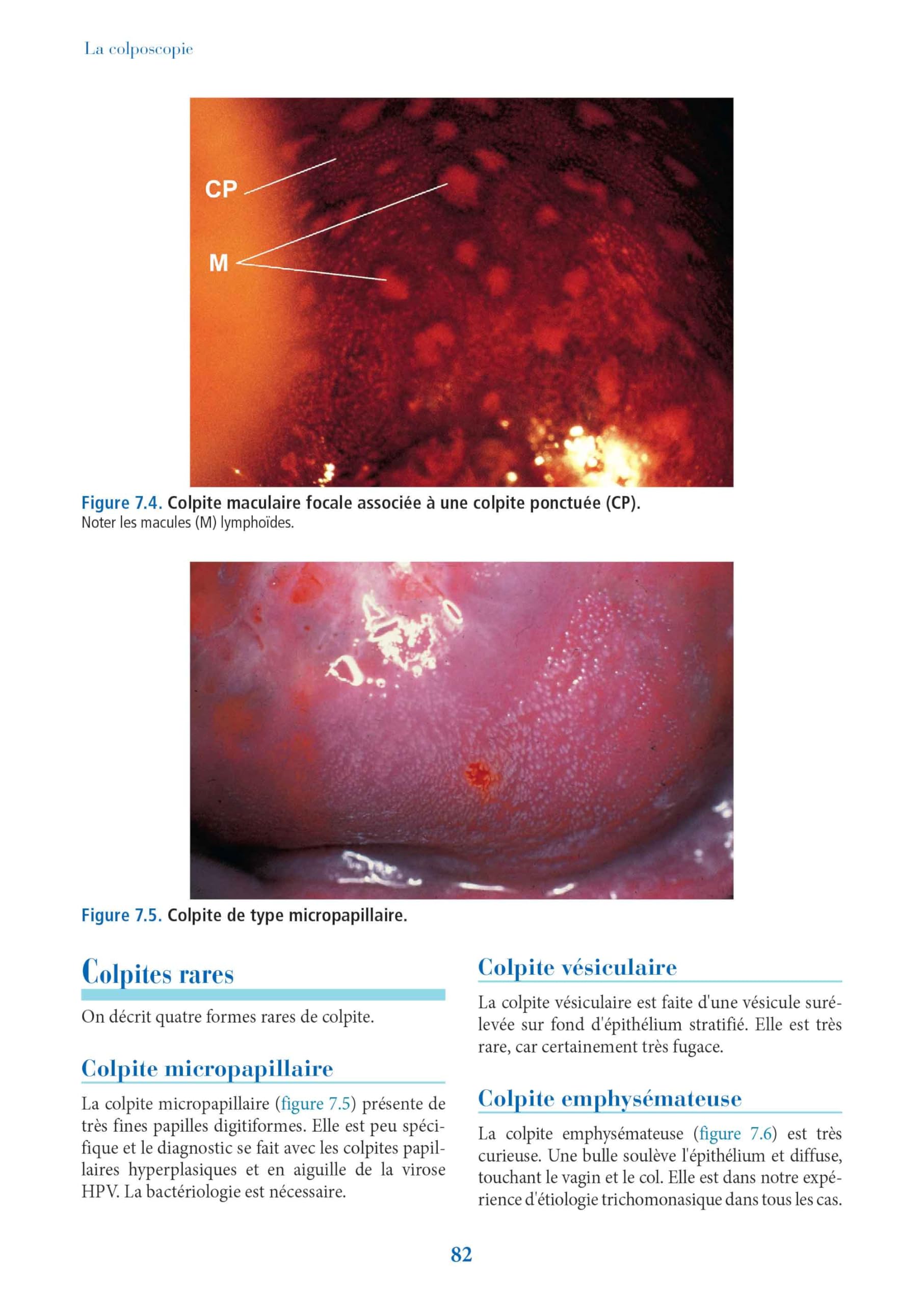 La colposcopie: Techniques et diagnostics