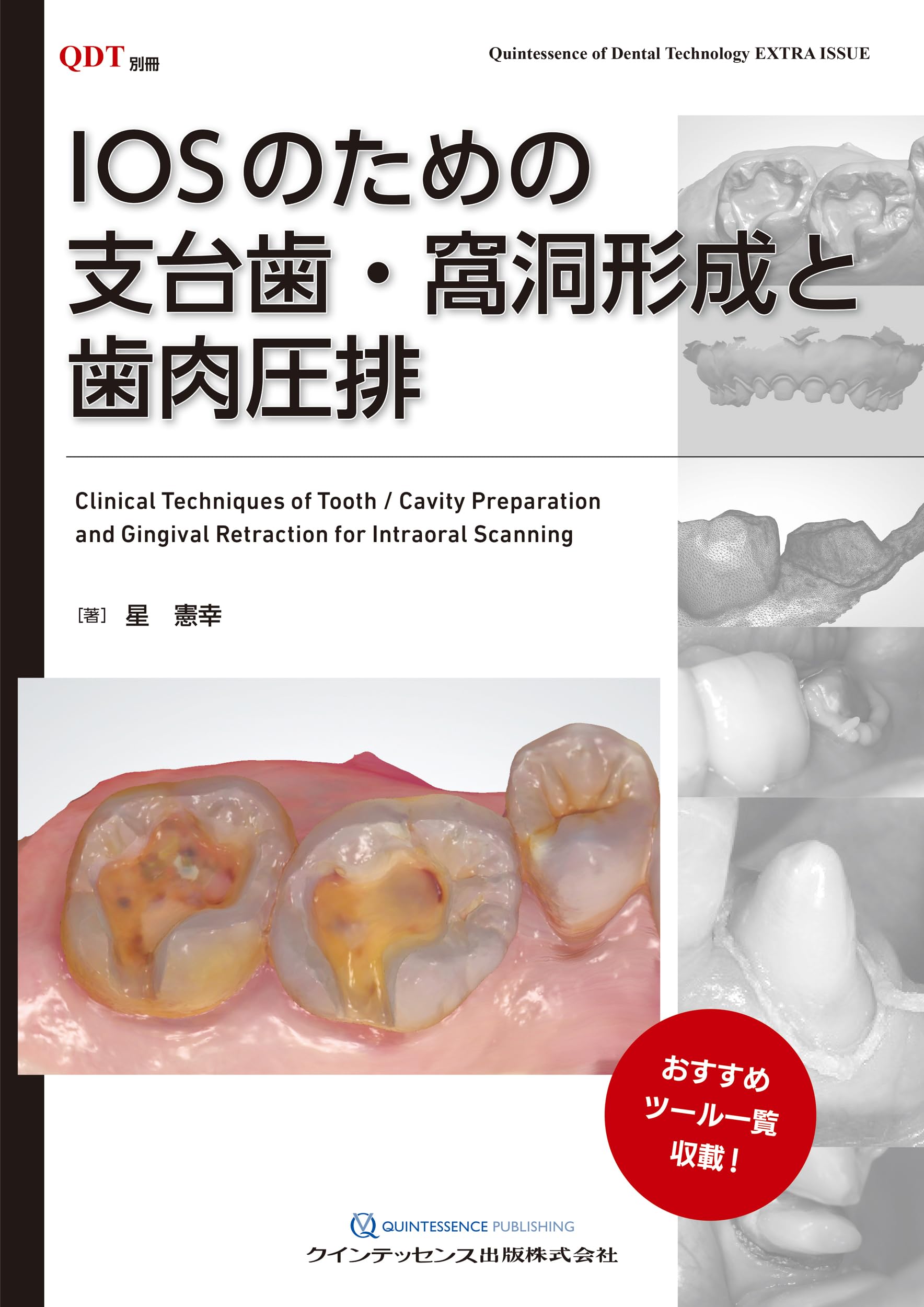 IOSのための支台歯・窩洞形成と歯肉圧排 (QDT別冊) | 星 憲幸 |本