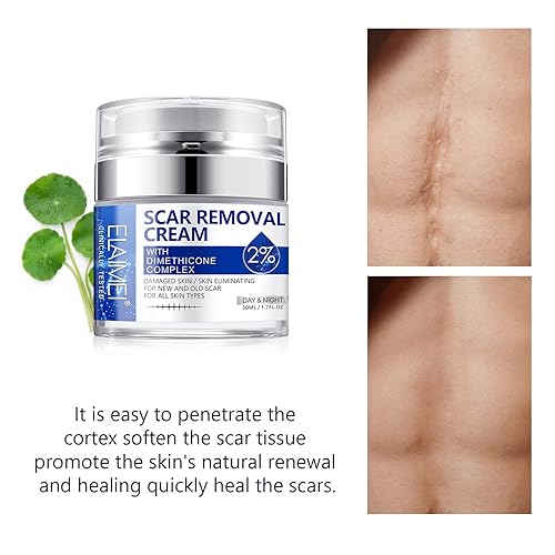 Miniatura 10 de Crema para eliminar cicatrices, gel avanzado para tratamiento de cicatrices quirúrgicas, cicatrices de acné, cesárea, quemaduras, estrías, para