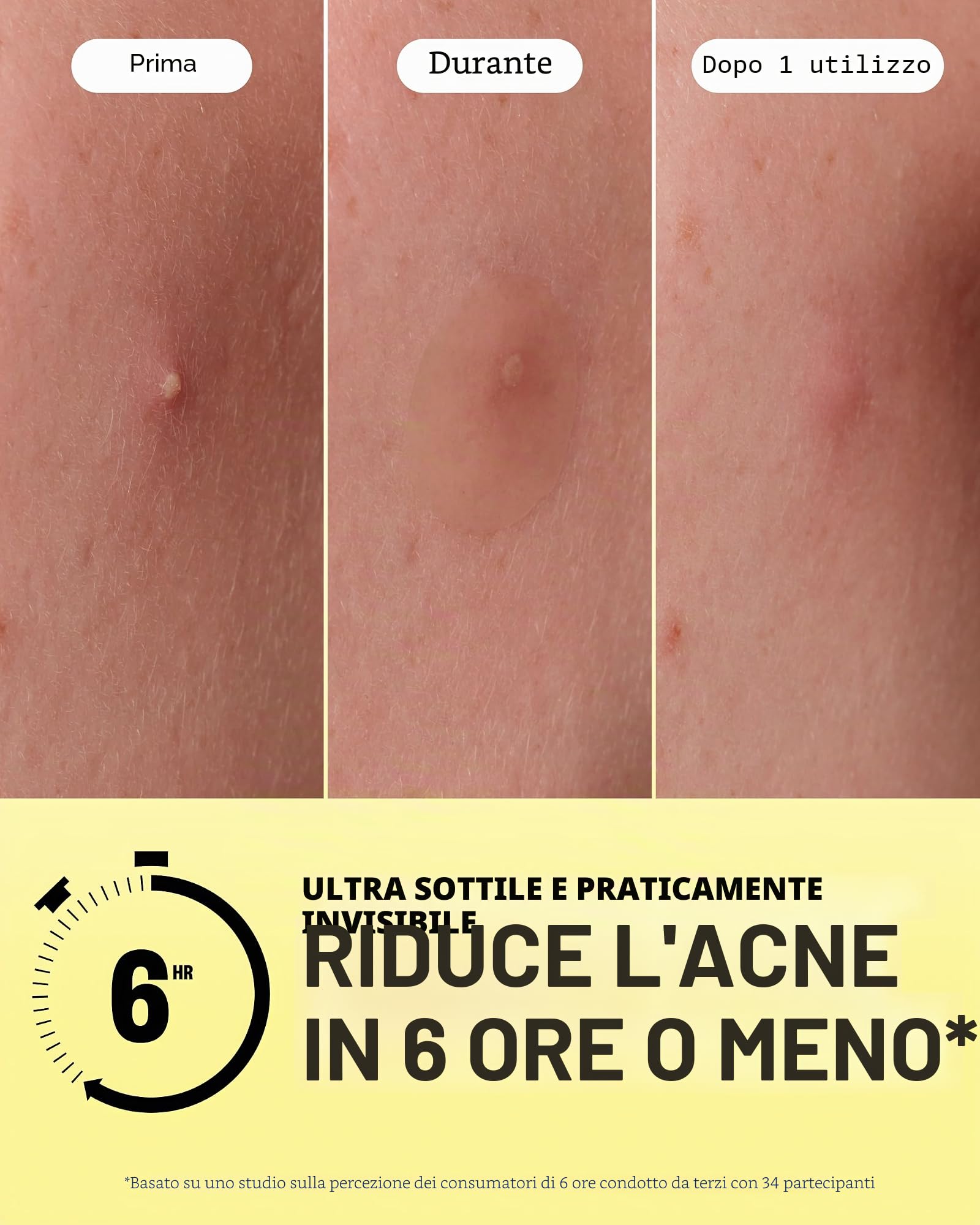 Peace Out Skincare Acne Day Dot Jumbo, cerotti idrocolloidali velati ad azione rapida con acido salicilico, ultra sottili, praticamente invisibili, eliminano rapidamente scoppi, imperfezioni e brufoli