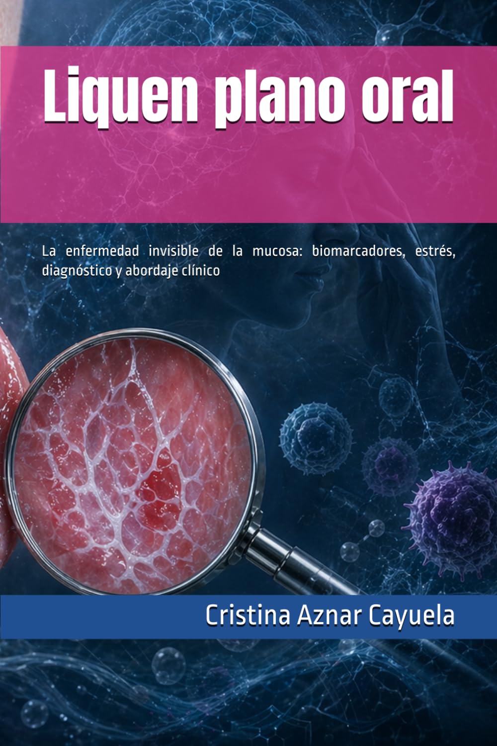 Liquen plano oral: La enfermedad invisible de la mucosa: biomarcadores, estrés, diagnóstico y abordaje clínico