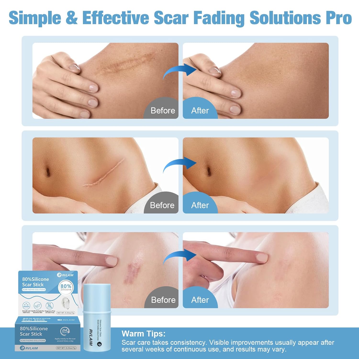 Silicone Scar Stick, 80% Silicone Stick for Face and Body. Silicone Stick for Removal of Surgical,Old and Recent Scars and Stretch Marks - 7g - Image 4