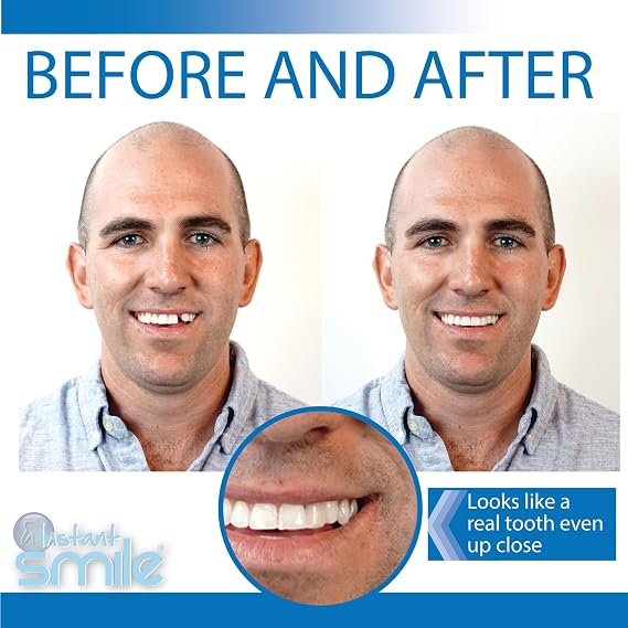 Instant Smile Pro Series Temporary Tooth Kit - With extra pack of fitting beads