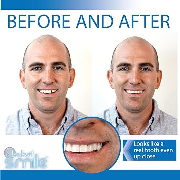 Instant Smile Pro Series Temporary Tooth Kit - With extra pack of fitting beads