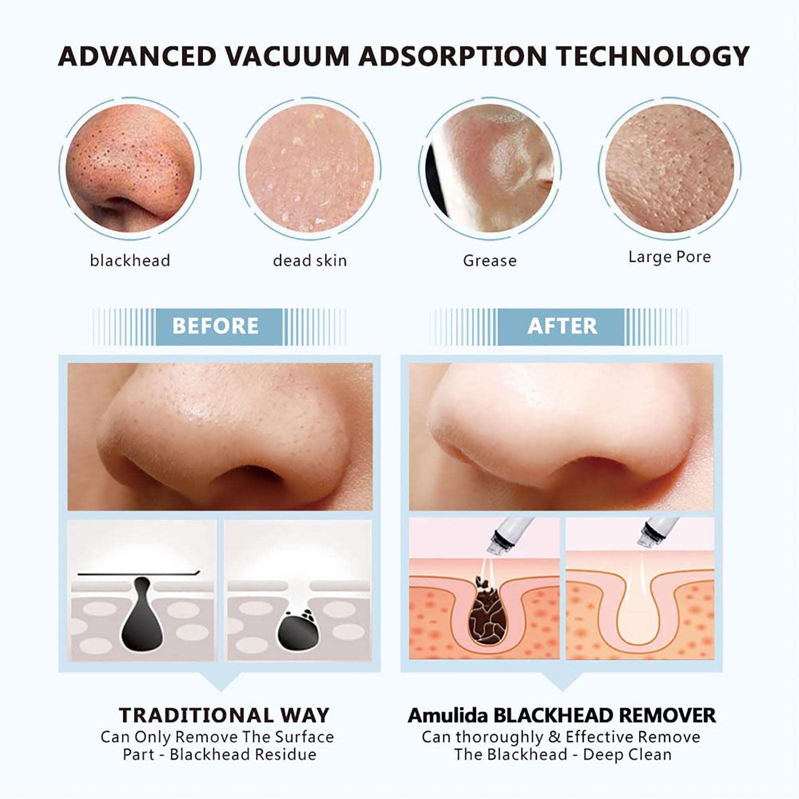 WolFum Kit de extractor de acné eléctrico – Herramienta de succión de puntos negros, herramienta de extracción de puntos blancos de comedones de acné, aspiradora de poros para eliminar puntos negros,