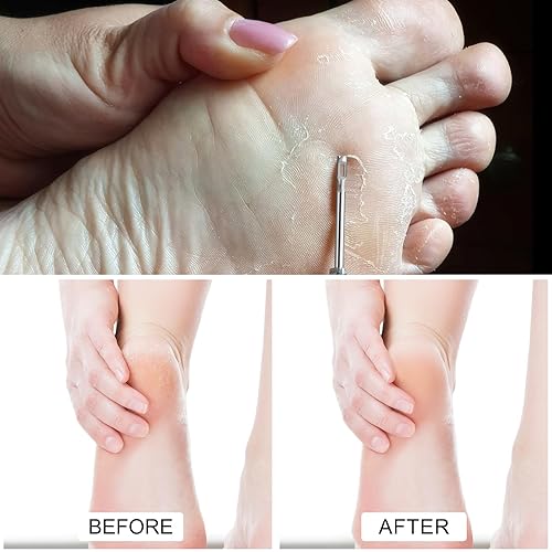 Miniatura 5 de Broca eliminadora de maíz de acero inoxidable, pedicura médica, eliminación más rápida, piel agrietada, callos de pies, cortador de cutículas,