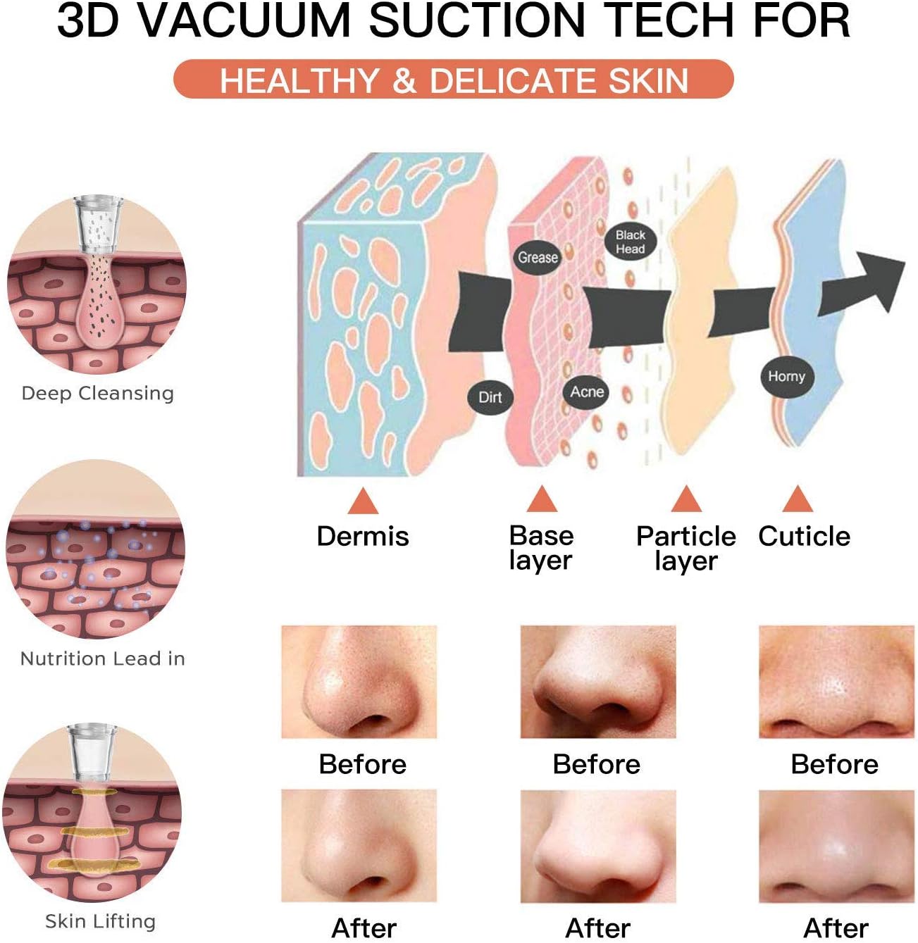 Blackhead Remover Vacuum, Upgraded Amicool Blackhead Extractor Suction Tool Facial Pore Cleaner with 5 Probes, Hot Compress Electric Acne Comedone Extraction Device LED USB Rechargeable All Skin