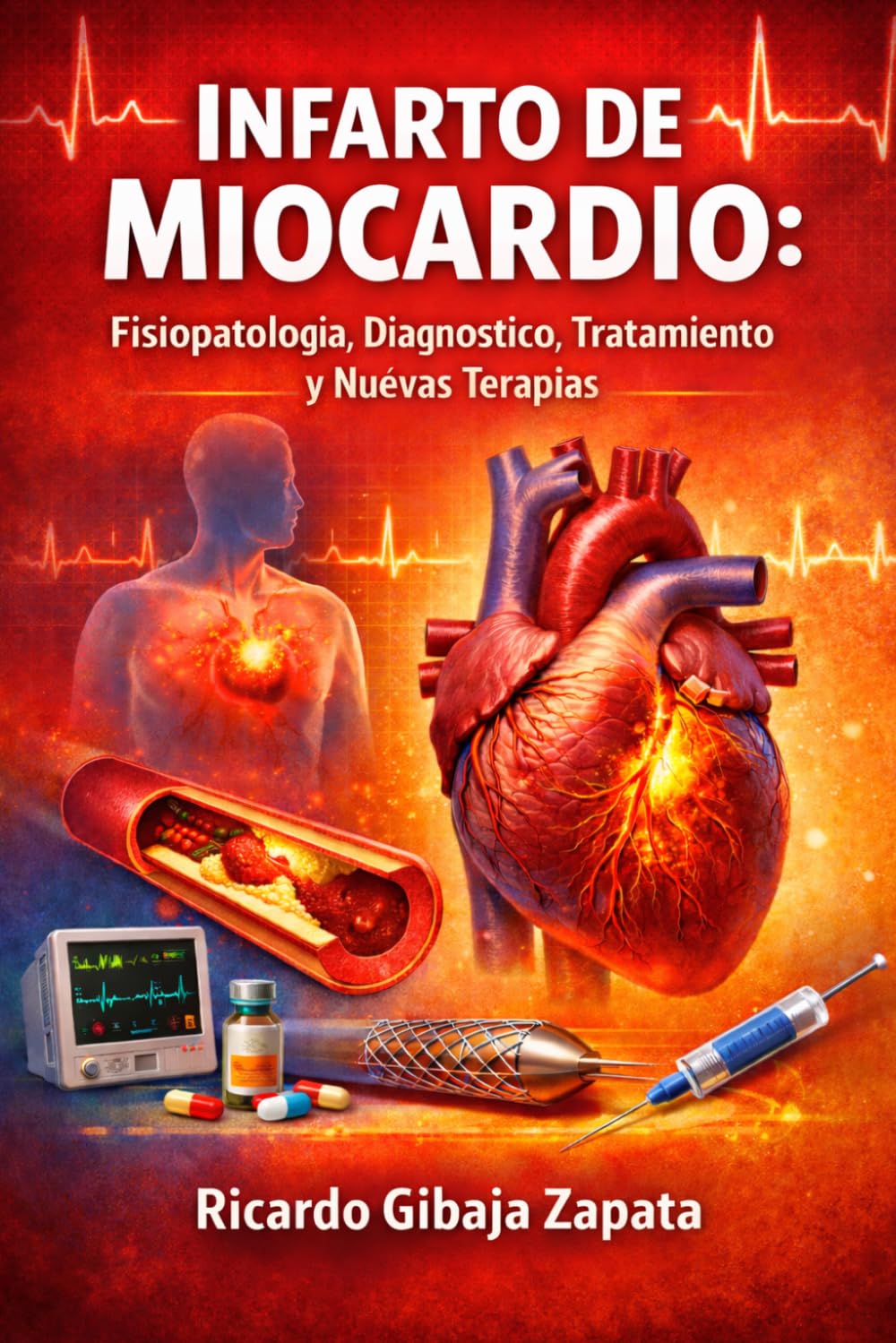 Infarto de Miocardio Fisiopatología, Diagnóstico, Tratamiento y Nuevas Terapias