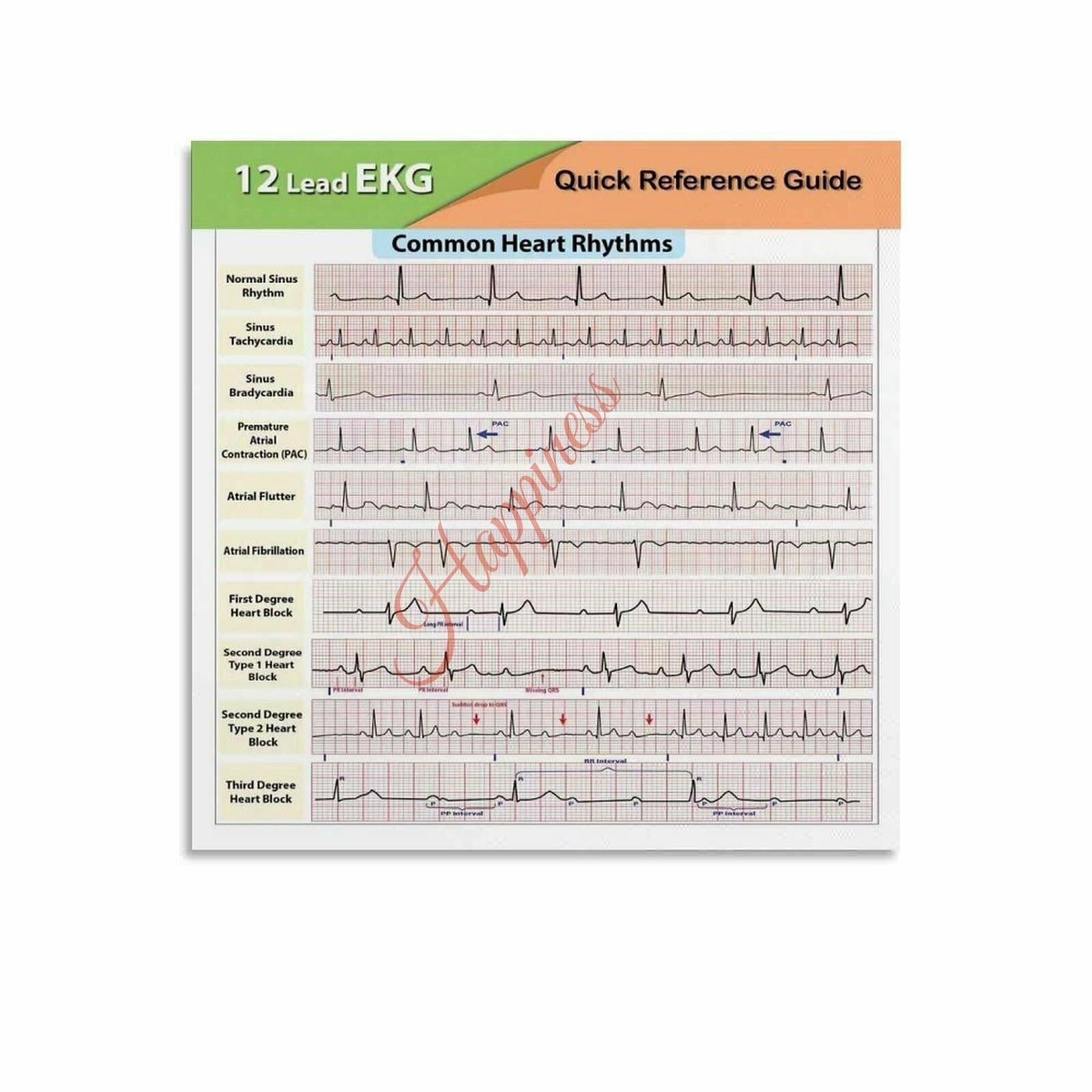 NWPNLXEA EKG Rhythm Identification Chart Sinus Bradycardia Supraventricular Tachycardia and Ventricular Fibrillation(Unframed,08x12inch(20x30cm))