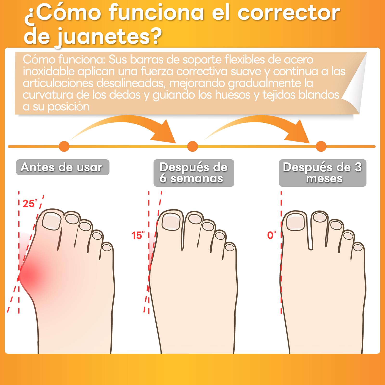 Corrector de hallux valgus InhwRior, equipado con 4 barras flexibles de acero inoxidable, 2 en cada lado, con almohadillas de amortiguación de silicona, mejora indolora de la condición del pie;lavable