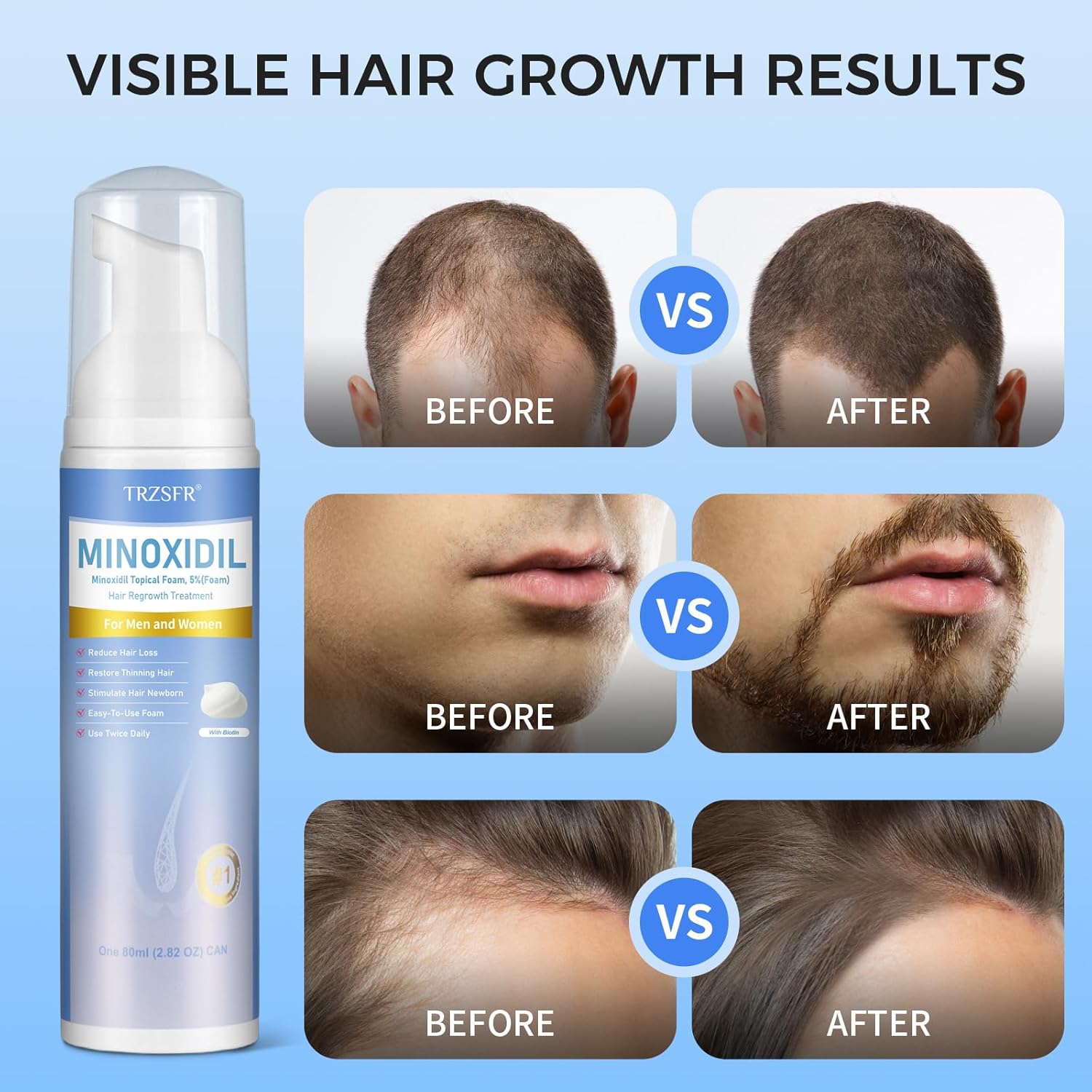 5% Minoxidil Foam for Men & Women, Hair Regrowth Treatment for Thinning Hair & Beard Growth, Extra Strength Topical Foam, Clinically Proven Hair Loss Treatment, 6 Month Supply (14OZ Total) - Image 4