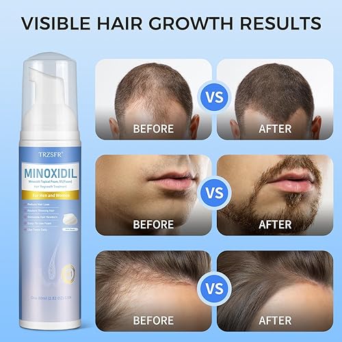Miniatura 4 de Espuma de minoxidil al 5% para hombres y mujeres, tratamiento de crecimiento del cabello para adelgazar el cabello y el crecimiento de la barba,