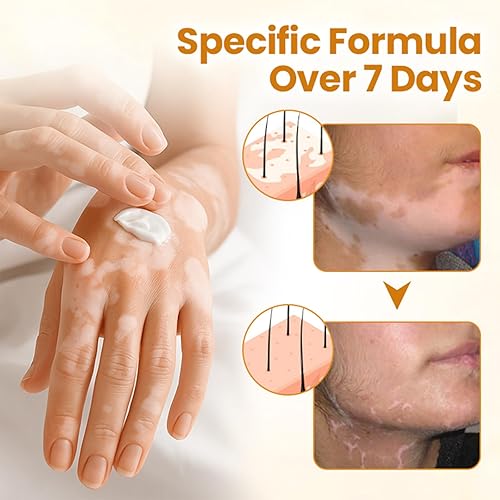 Miniatura 4 de Timilk VitiCalm - Crema de veneno de abeja, crema de vitíligo profesional, tratamiento natural de vitíligo, reduce las manchas blancas y mejora la