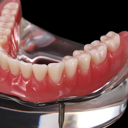 Miniatura 3 de Dientes dentales Modelo Typodont Restauración de implantes M6002 Sobredentadura 2 Implantes Inferior Inferior Demo para Estudio Enseñar