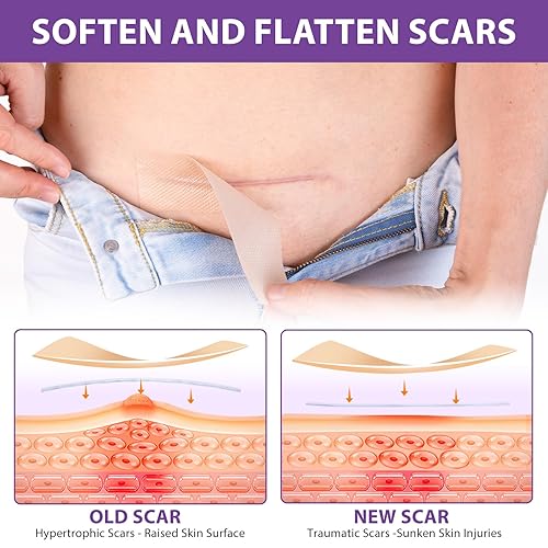 Miniatura 6 de Hojas de silicona para cicatrices, hojas de silicona para cicatrices, cinta de silicona para cicatrices quirúrgicas, cinta de cicatriz de grado