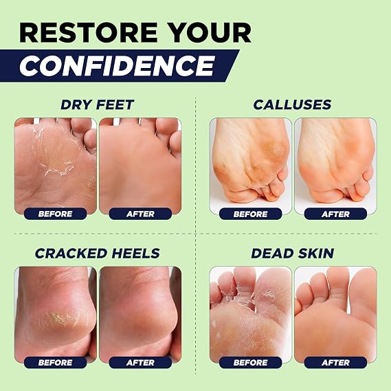 Tea Tree Callus Remover Gel for Dry Cracked Feet, Hard Calluses & Dead Skin