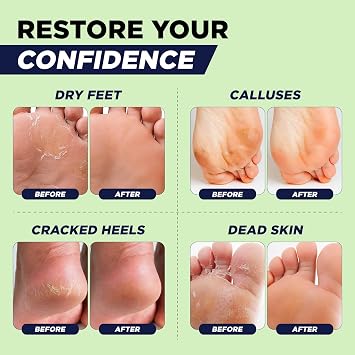 Tea Tree Callus Remover Gel for Dry Cracked Feet, Hard Calluses & Dead Skin