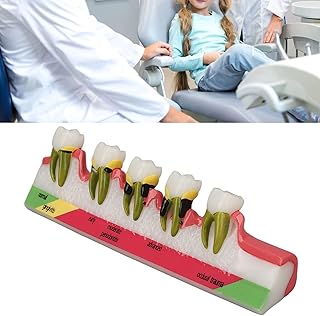 Disease Display Model, Tooth Model Dental Teeth Power Dental Flossers Teeth Periodontitis Model Different Stages Resin Dental Periodontitis Display Model Dental Caries Tooth
