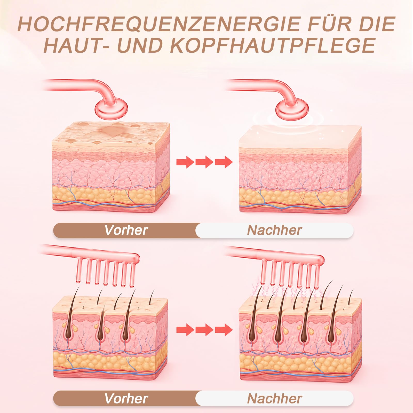 Yofuly Hochfrequenzstab-Hochfrequenz Gerät Akne mit 4 Rote Stab-Schläuchen für Haarwuchs/Aknebehandlung/Faltenreduzierung/Hautstraffung