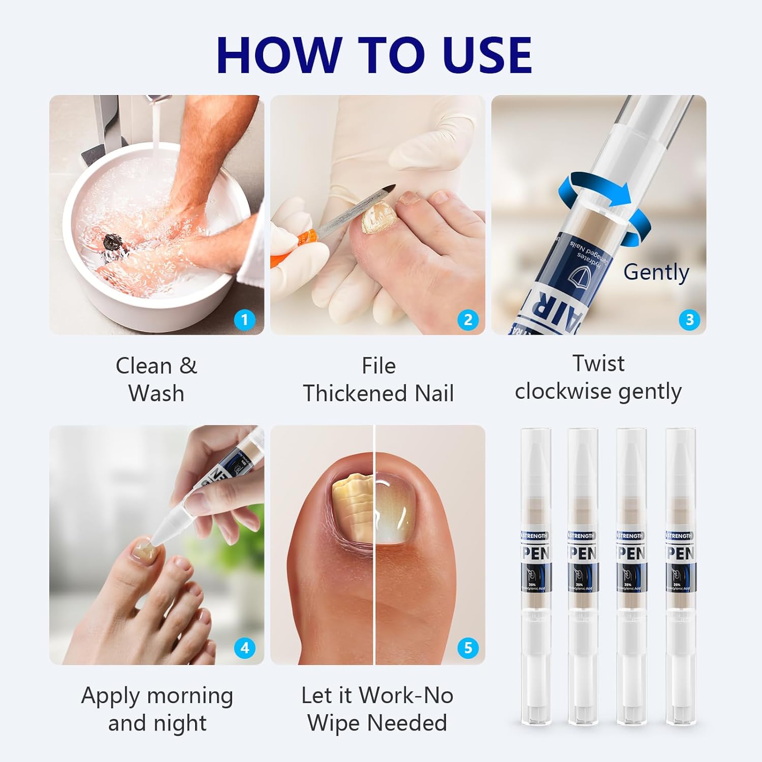 iKeener Toe Nail Fungus Treatment Pen - 25% Undecylenic Acid, Tea Tree Oil Extra Strength for Toenails and Fingernails, 0.4 Fl Oz (Pack of 4) - Image 7