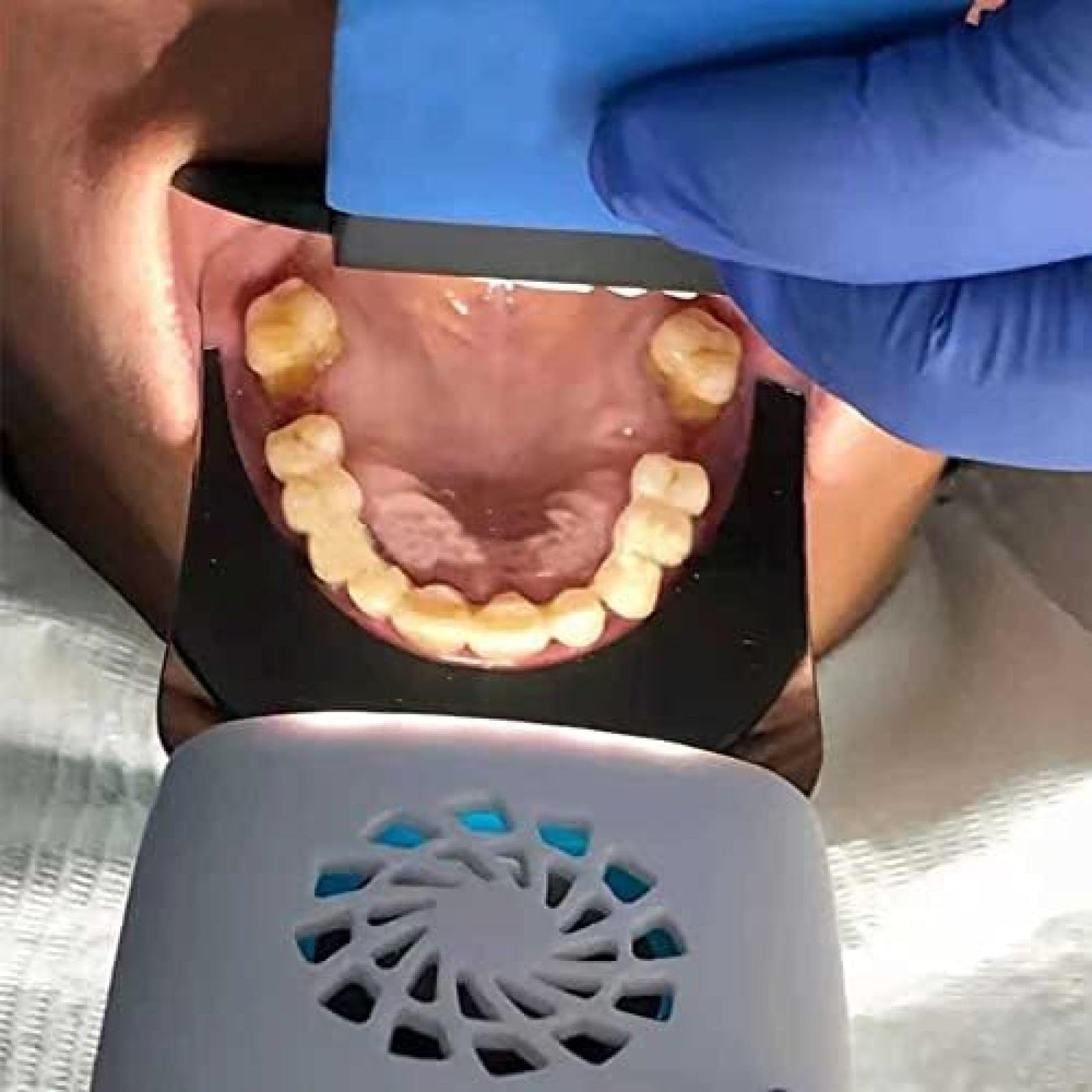 Espejos intraorales antivaho con Mango, kits de Cuidado Dental, Espejos de fotografía Dental, Espejo de ortodoncia LED Reflector Dental de Doble Cara