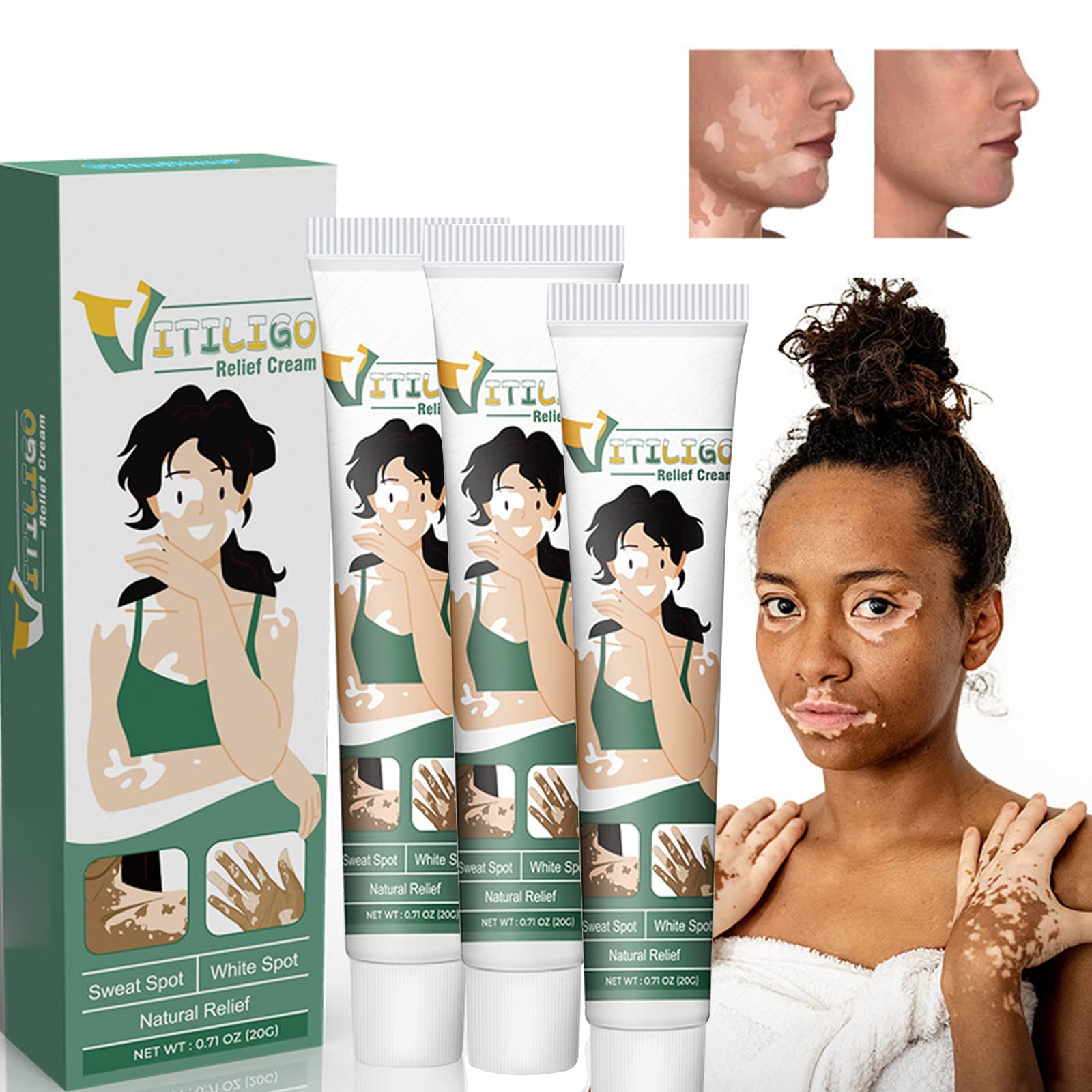 Buy Shinyme Vitiligo Skin Repair Cream, Vitiligo Cream, Vitiligo Care