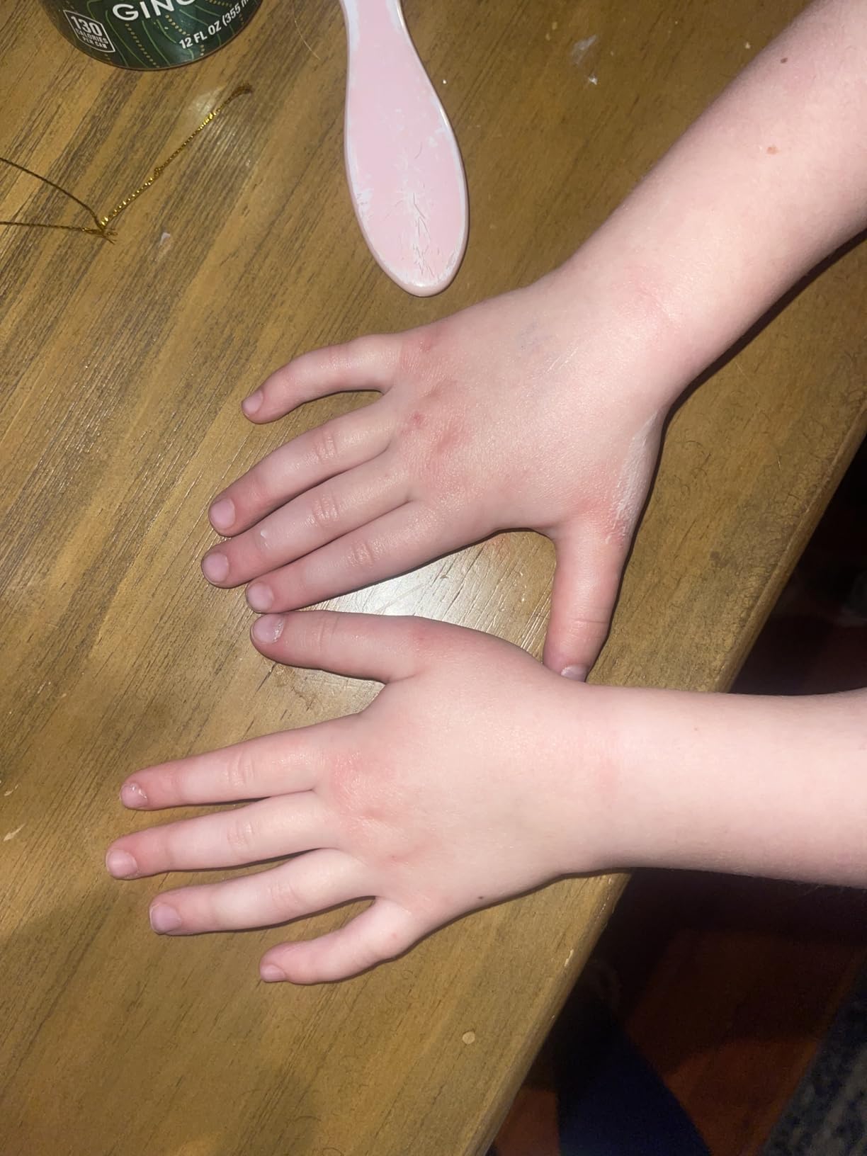 Before — child's hand eczema