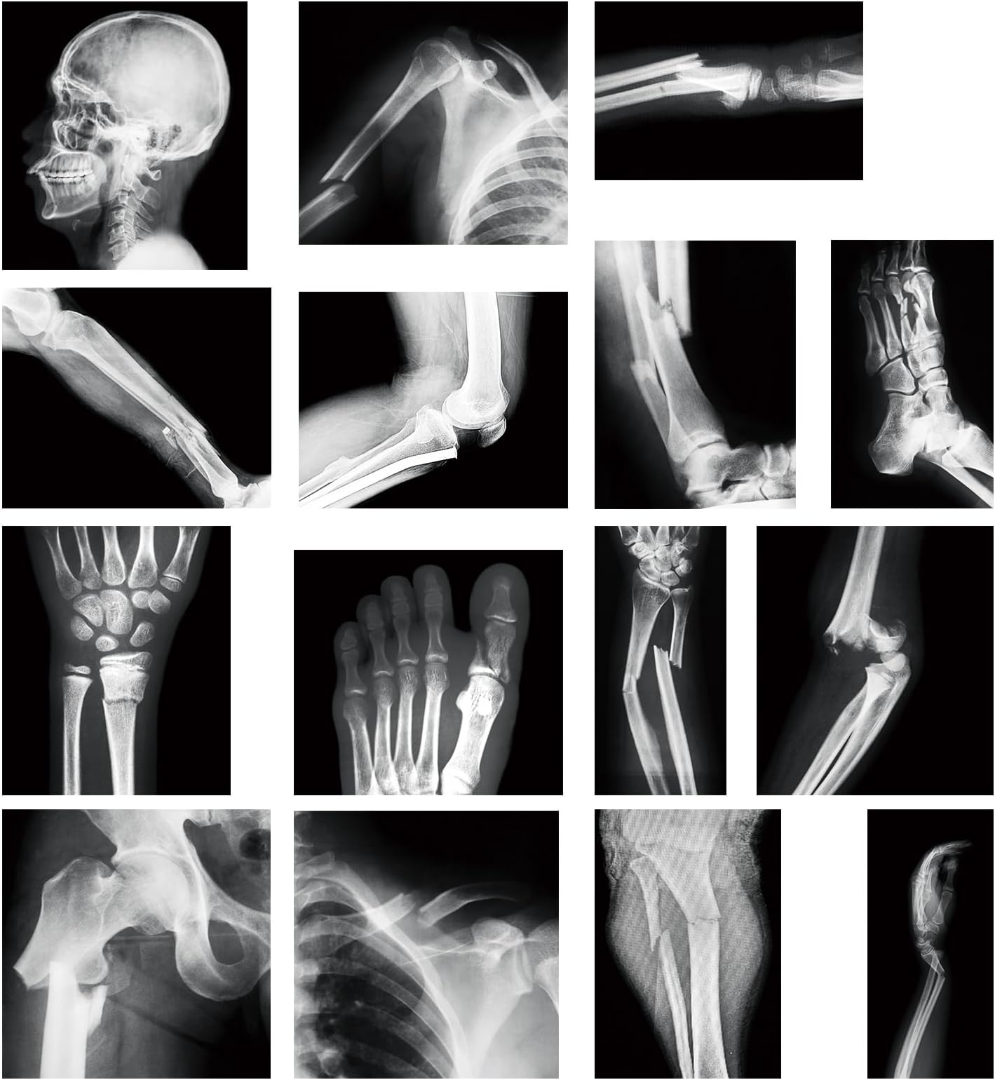 Sayglossy 15 Pcs Broken Bones x Ray Set Human x Rays Black and White Skeleton Pretend Xrays for Kids