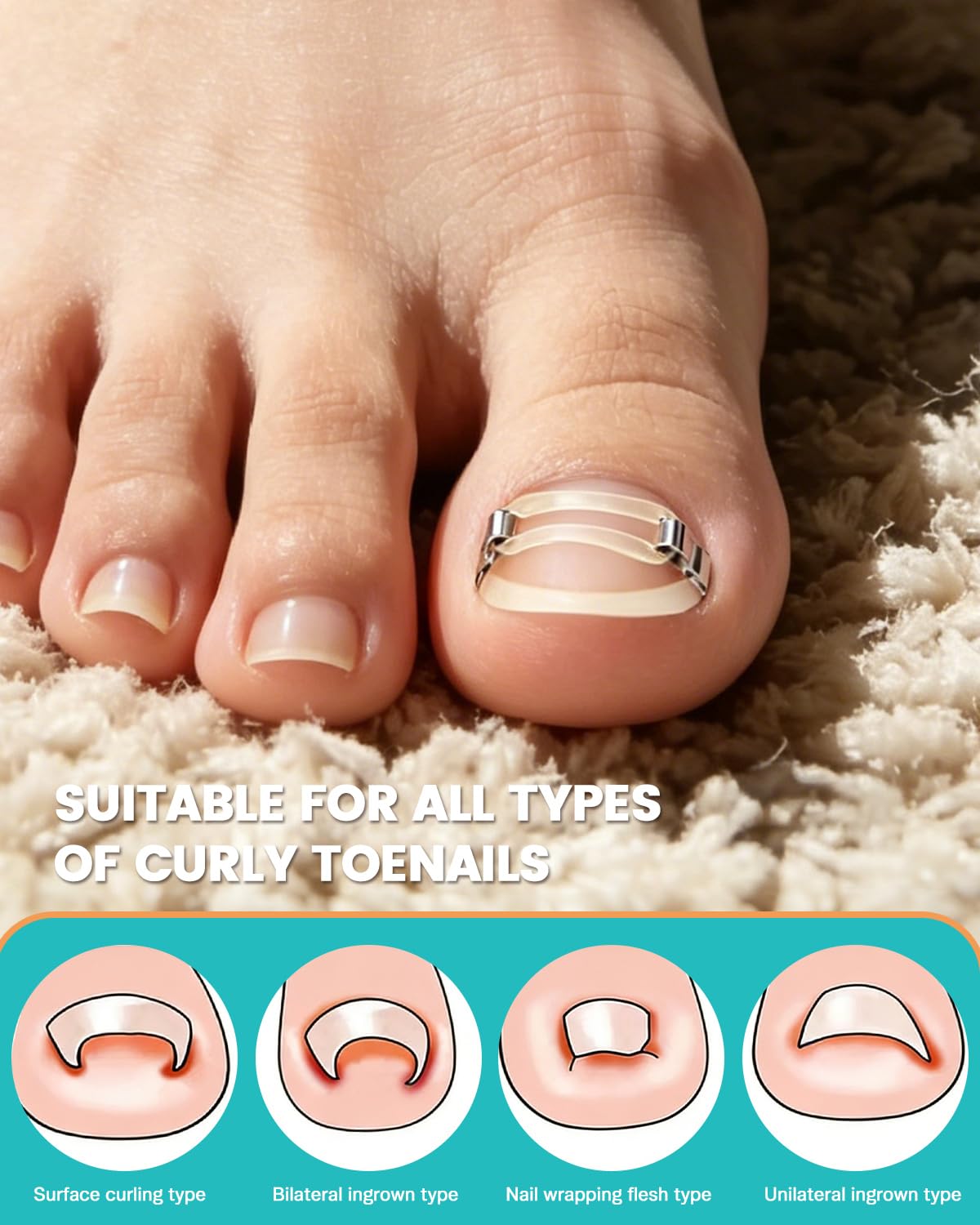 BEZOX Correcteur d'ongles incarnés, application facile à la maison