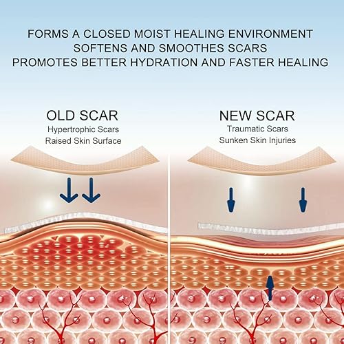 Miniatura 4 de Cinta de silicona para cicatrices (hojas de cicatriz de silicona) para cicatrices quirúrgicas, borrador de cicatrices de abdominoplastia, cicatrices