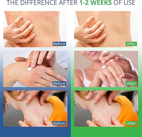 Miniatura 6 de Jock - Crema para la picazón, crema para la psoriasis, tratamiento para la tiña para humanos, tratamiento para la psoriasis, tratamiento para el