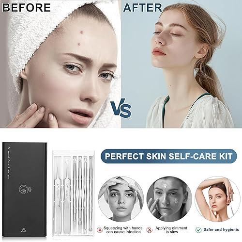 Miniatura 2 de Pinzas profesionales para eliminar puntos negros, juego de 6 herramientas de acero inoxidable para extractor de acné con estuche de almacenamiento