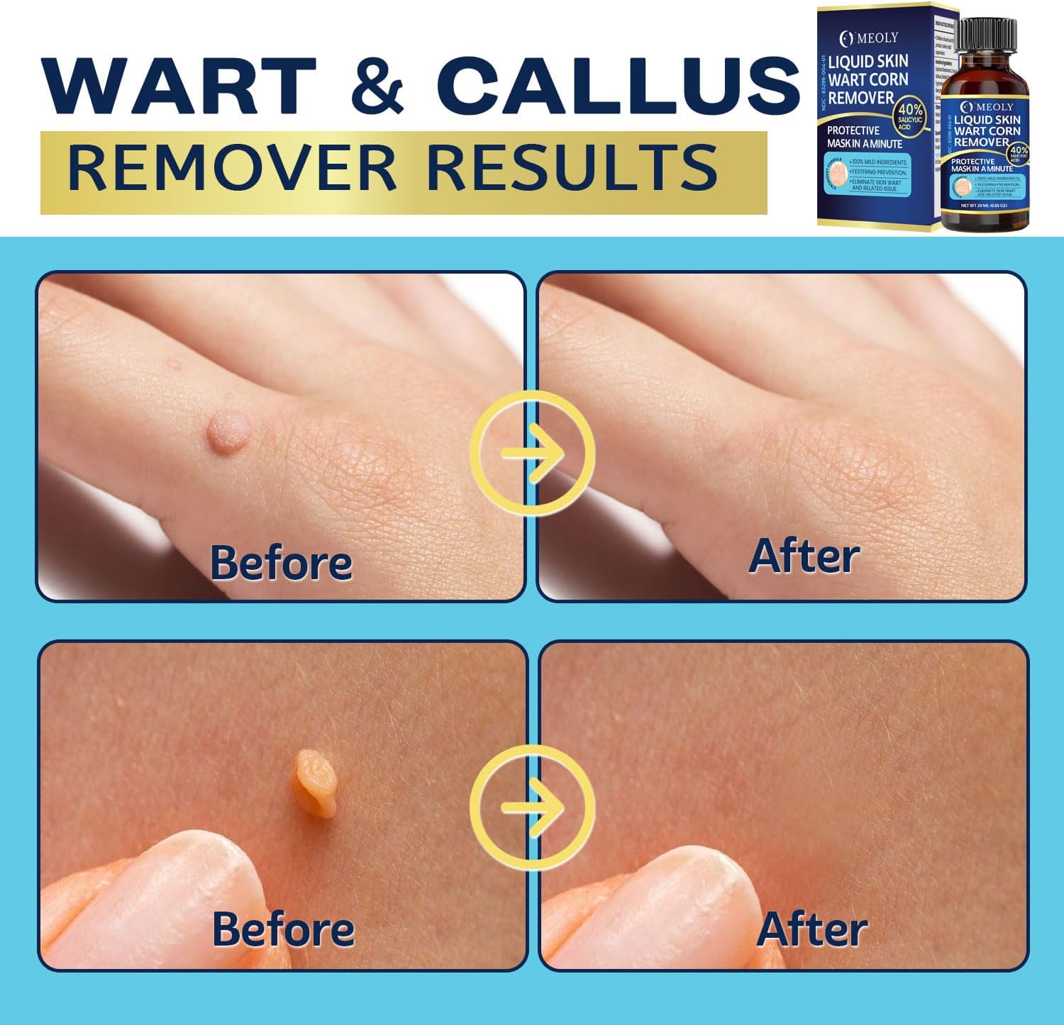 MEOLY Fast-Acting Wart Remover: 40% Salicylic Acid Wart Remover Maximum Strength for Plantar Wart, Corn Men and Women