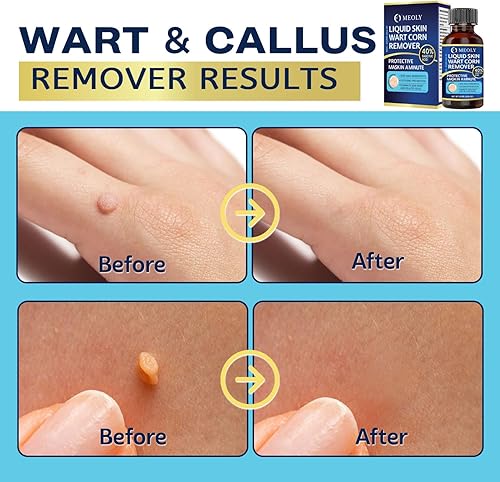 Miniatura 4 de MEOLY Removedor de verrugas de acción rápida 40% de ácido salicílico removedor de verrugas máxima fuerza para verrugas plantares, maíz hombres y