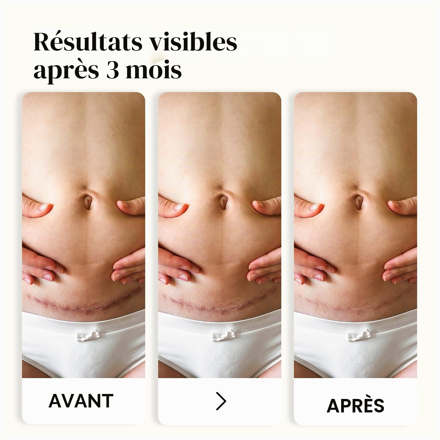 Dermatix Ultra Gel anti-cicatrices postopératoire soin des cicatrices 15 g